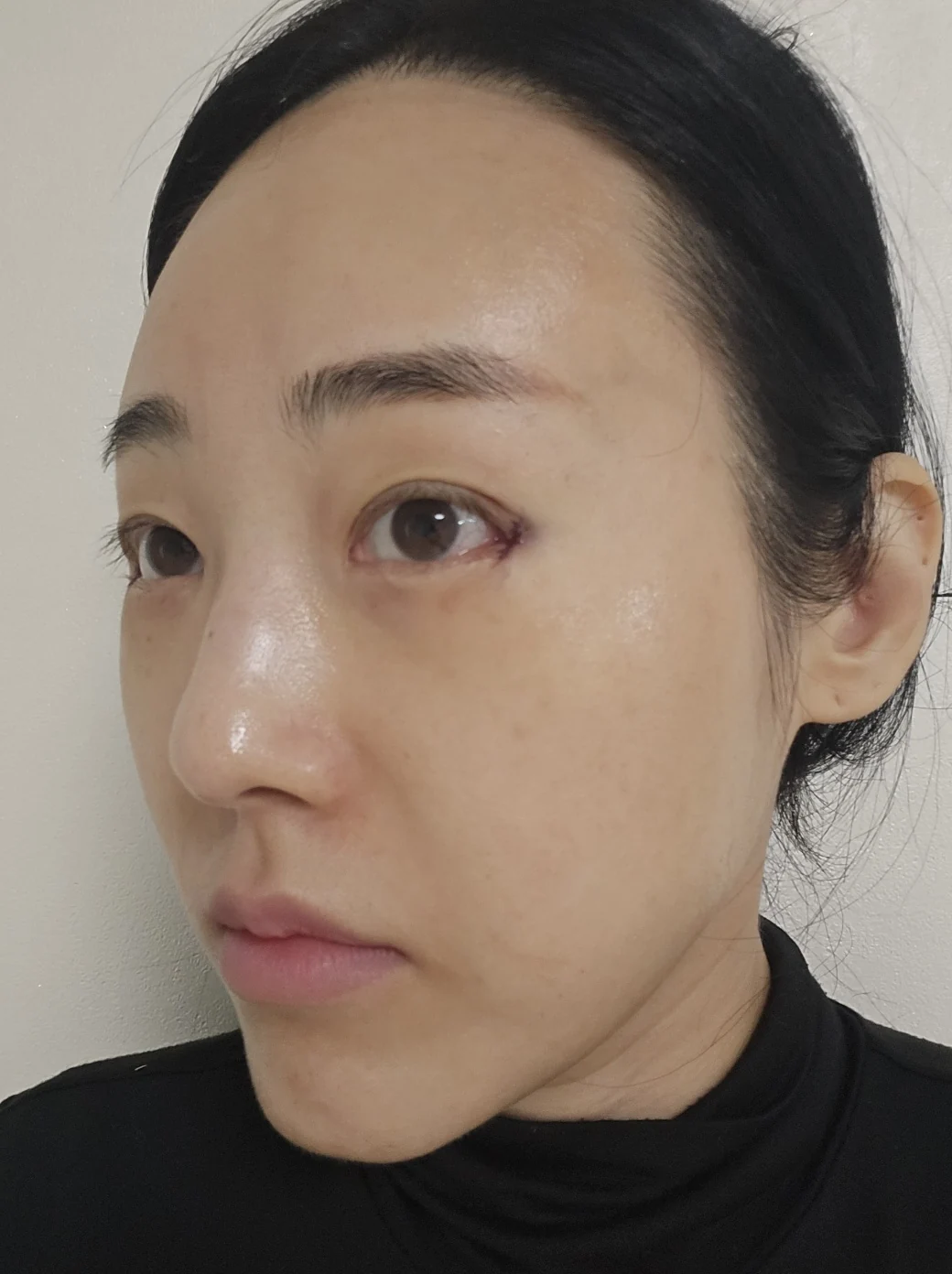Revision outer-corner eye surgery: two-week follow-up · Case 028 at Answer Plastic Surgery. Oblique view — day of surgery at Answer Plastic Surgery.