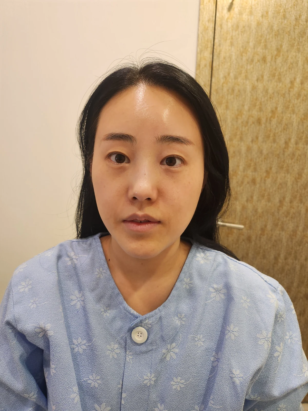 Revision outer-corner eye surgery: two-week follow-up · Case 028 at Answer Plastic Surgery. Front view — before at Answer Plastic Surgery.