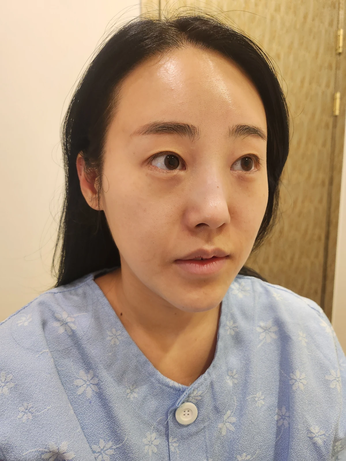 Revision outer-corner eye surgery: two-week follow-up · Case 028 at Answer Plastic Surgery. Oblique view — before at Answer Plastic Surgery.