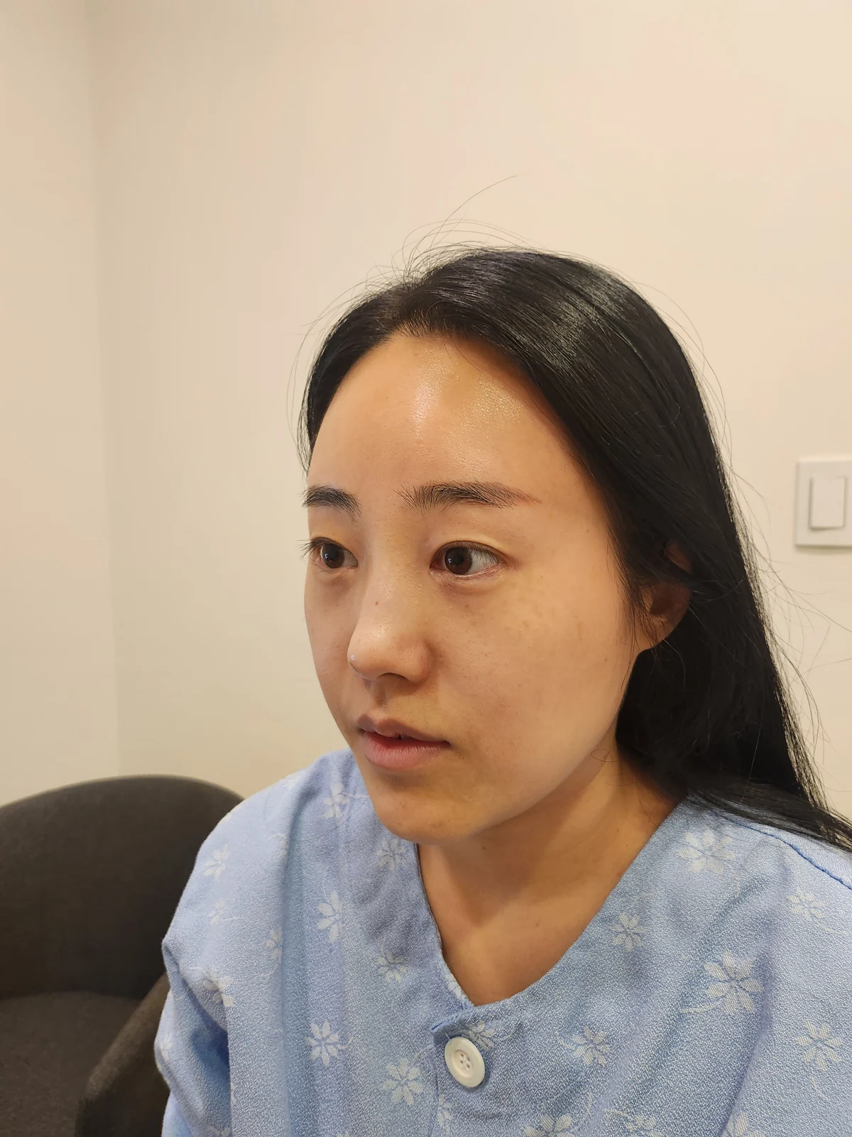 Revision outer-corner eye surgery: two-week follow-up · Case 028 at Answer Plastic Surgery. Opposite oblique view — before at Answer Plastic Surgery.