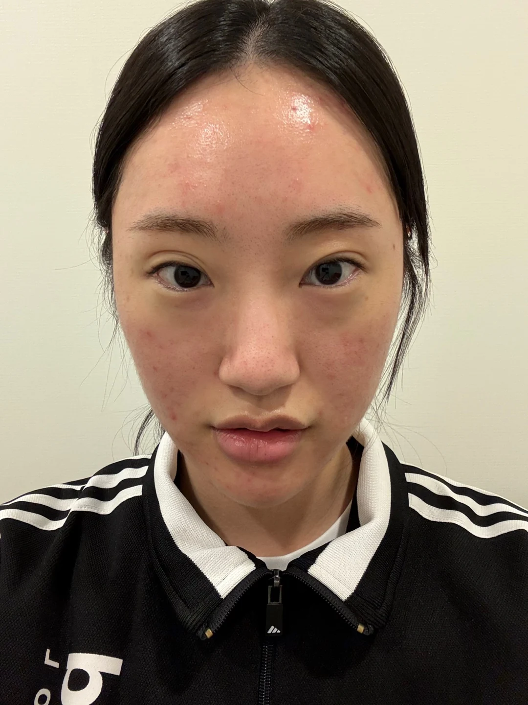 Eye-area before and after: one-month photo comparison · Case 029 at Answer Plastic Surgery. Front view — before at Answer Plastic Surgery.