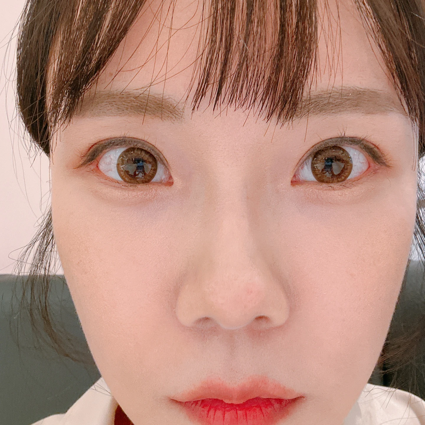 Eye-area photos from treatment day to two months · Case 030 at Answer Plastic Surgery. Front view with coloured contact lenses — 2 months at Answer Plastic Surgery.
