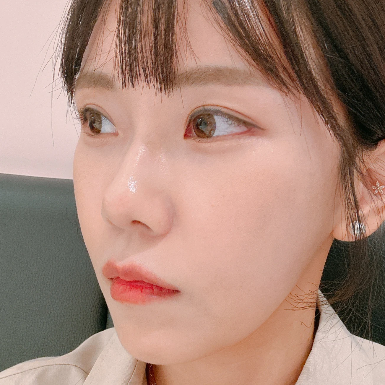 Eye-area photos from treatment day to two months · Case 030 at Answer Plastic Surgery. Oblique view with coloured contact lenses — 2 months at Answer Plastic Surgery.
