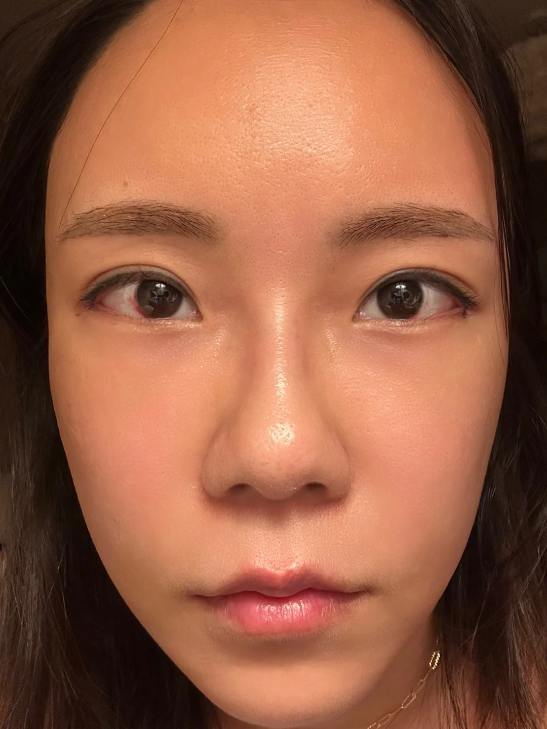 Eye-area photos from treatment day to two months · Case 030 at Answer Plastic Surgery. Front portrait — day of treatment at Answer Plastic Surgery.