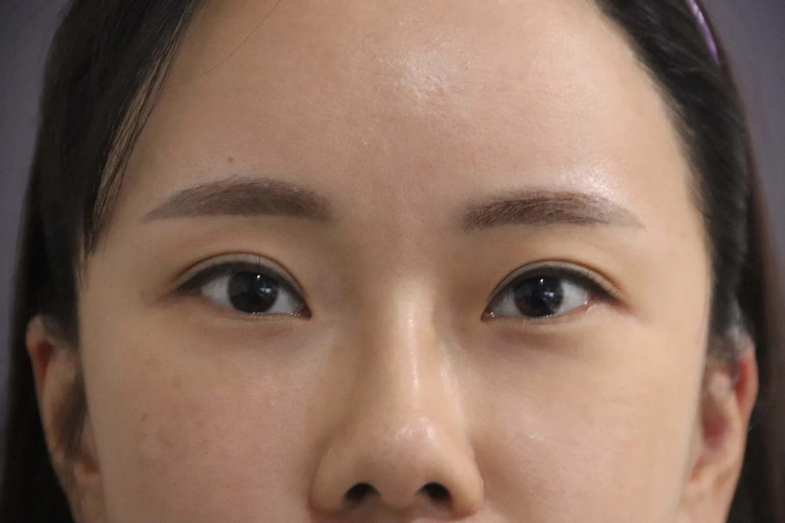 Eye-area photos from treatment day to two months · Case 030 at Answer Plastic Surgery. Eye-area front view — before at Answer Plastic Surgery.