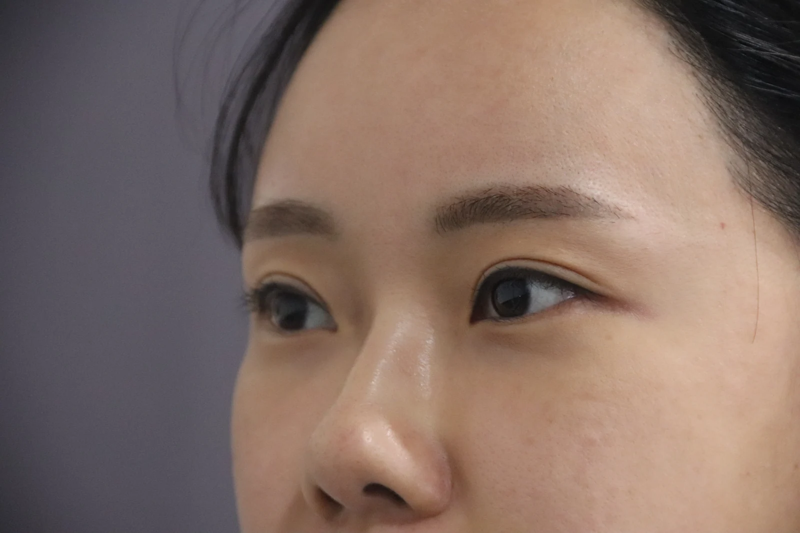 Eye-area photos from treatment day to two months · Case 030 at Answer Plastic Surgery. Eye-area oblique view — before at Answer Plastic Surgery.