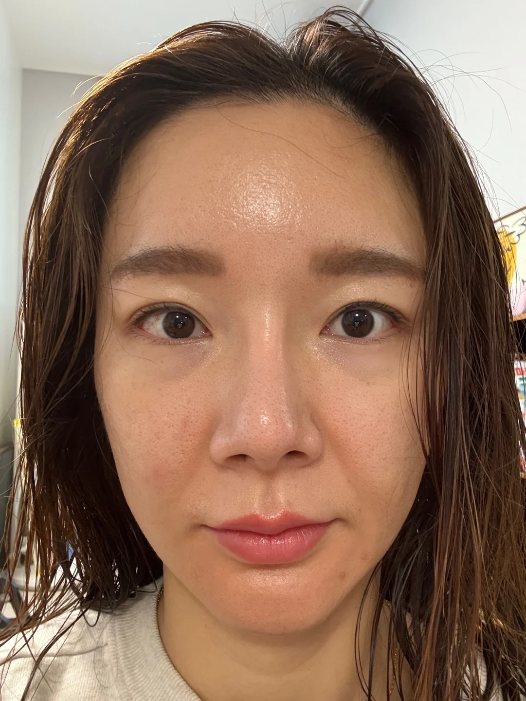 Revision lateral and lower canthoplasty: three-month timeline · Case 031 at Answer Plastic Surgery. Front view — 1 month at Answer Plastic Surgery.