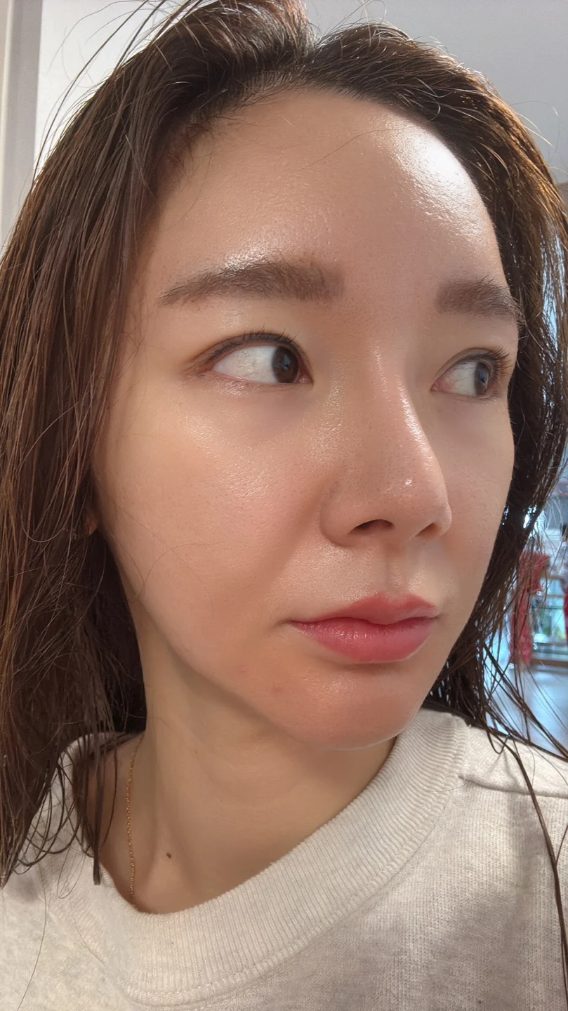 Revision lateral and lower canthoplasty: three-month timeline · Case 031 at Answer Plastic Surgery. Oblique view — 1 month at Answer Plastic Surgery.