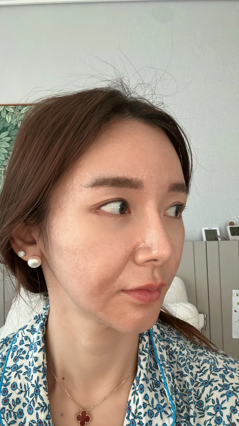 Revision lateral and lower canthoplasty: three-month timeline · Case 031 at Answer Plastic Surgery. Oblique view — 1 week at Answer Plastic Surgery.
