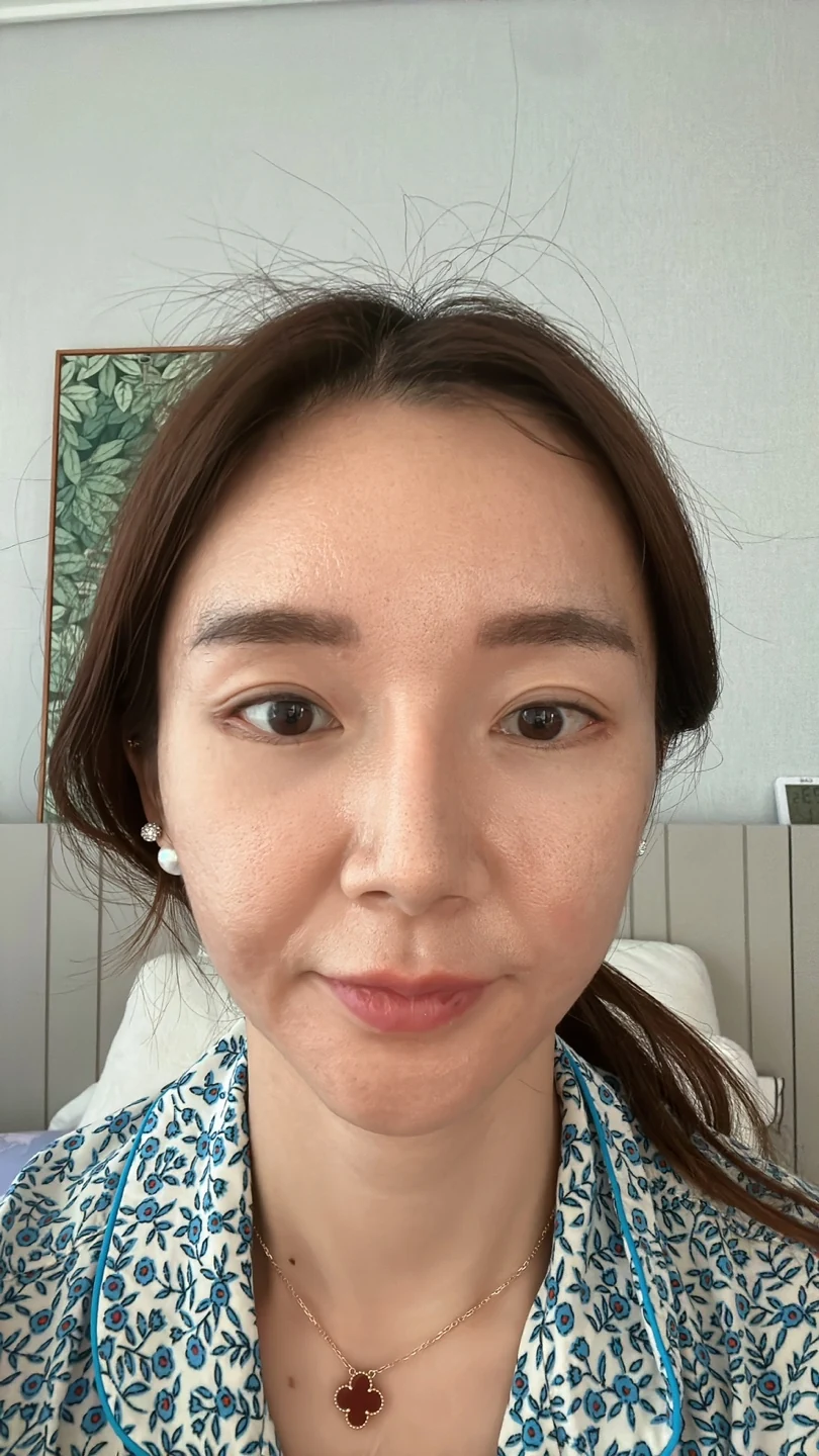 Revision lateral and lower canthoplasty: three-month timeline · Case 031 at Answer Plastic Surgery. Front view — 1 week at Answer Plastic Surgery.