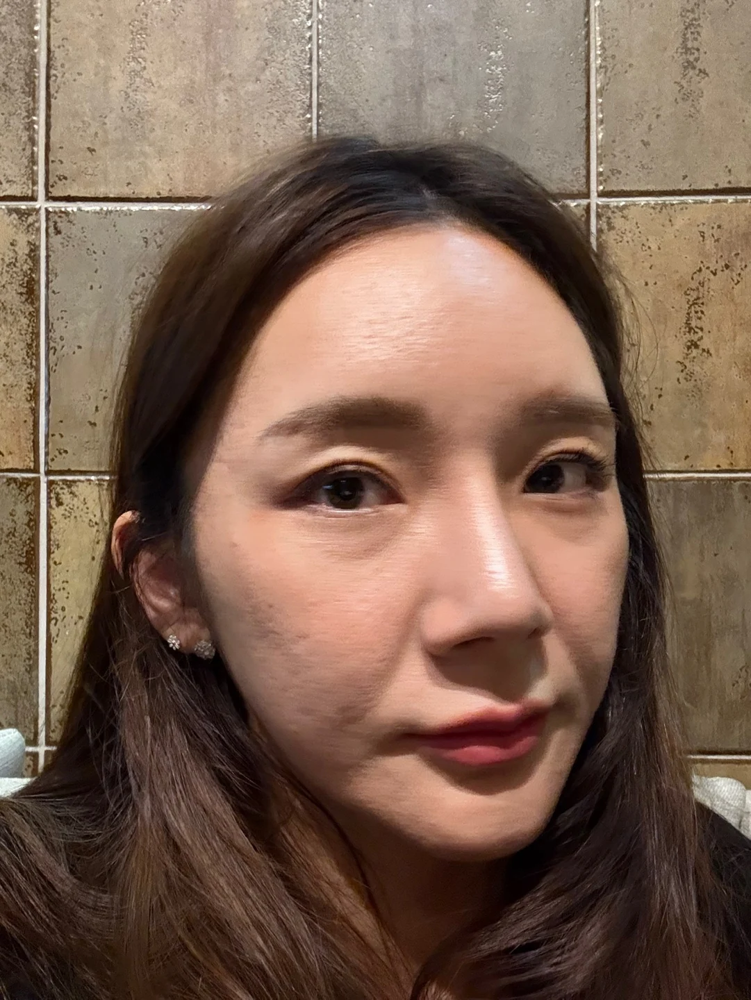 Revision lateral and lower canthoplasty: three-month timeline · Case 031 at Answer Plastic Surgery. Oblique view — 2 months at Answer Plastic Surgery.