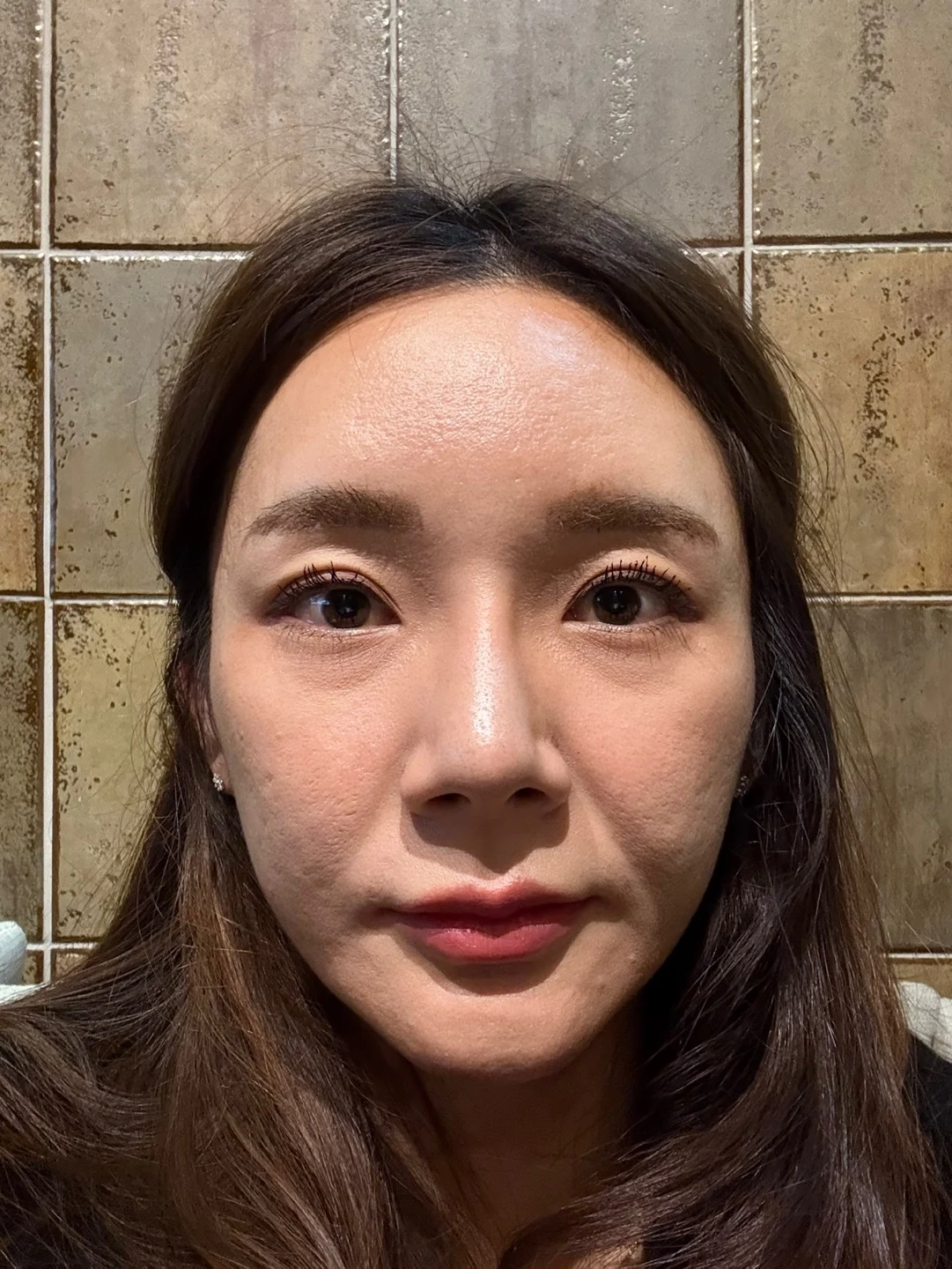 Revision lateral and lower canthoplasty: three-month timeline · Case 031 at Answer Plastic Surgery. Front view — 2 months at Answer Plastic Surgery.