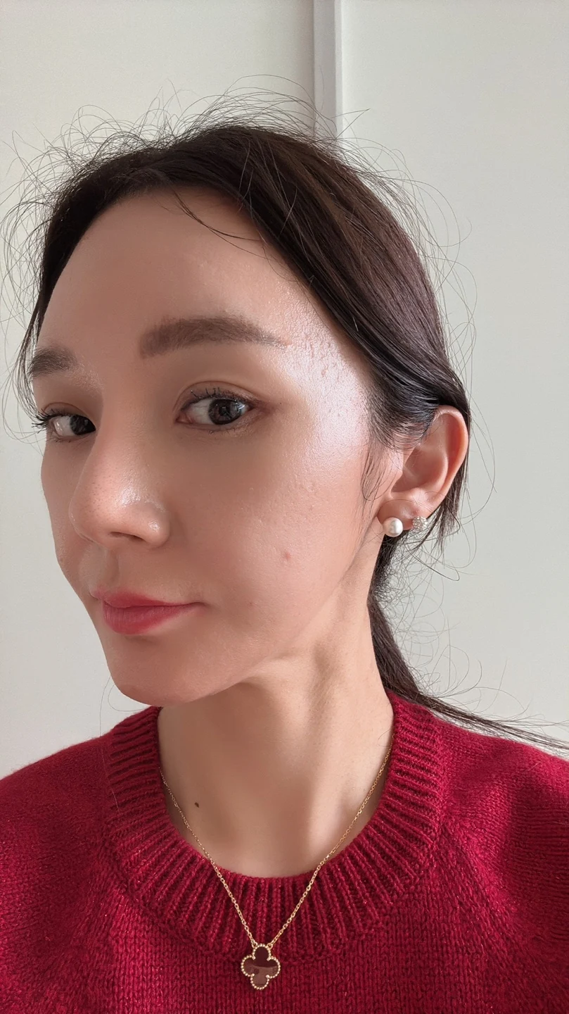 Revision lateral and lower canthoplasty: three-month timeline · Case 031 at Answer Plastic Surgery. Oblique view — 3 months at Answer Plastic Surgery.
