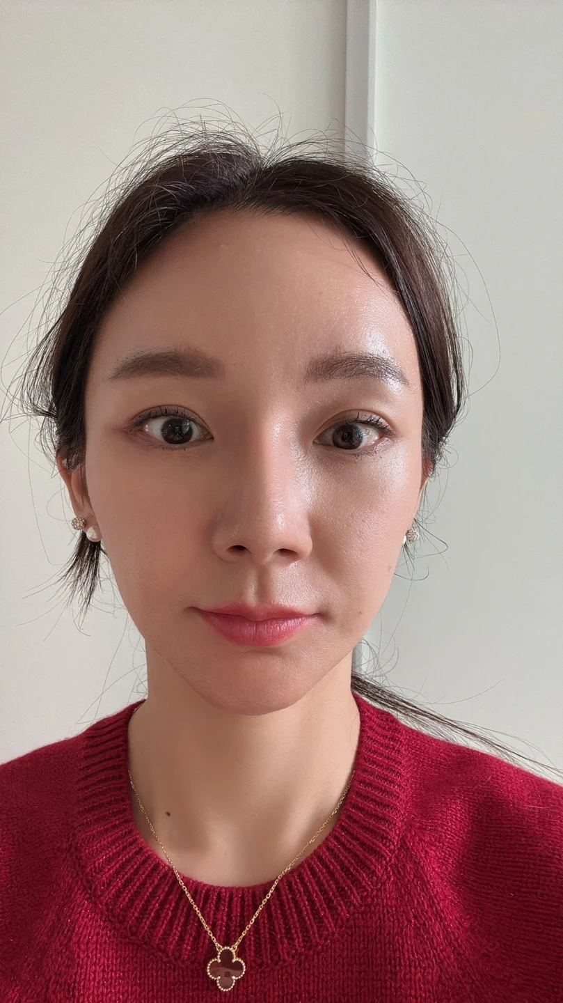 Revision lateral and lower canthoplasty: three-month timeline · Case 031 at Answer Plastic Surgery. Front view — 3 months at Answer Plastic Surgery.