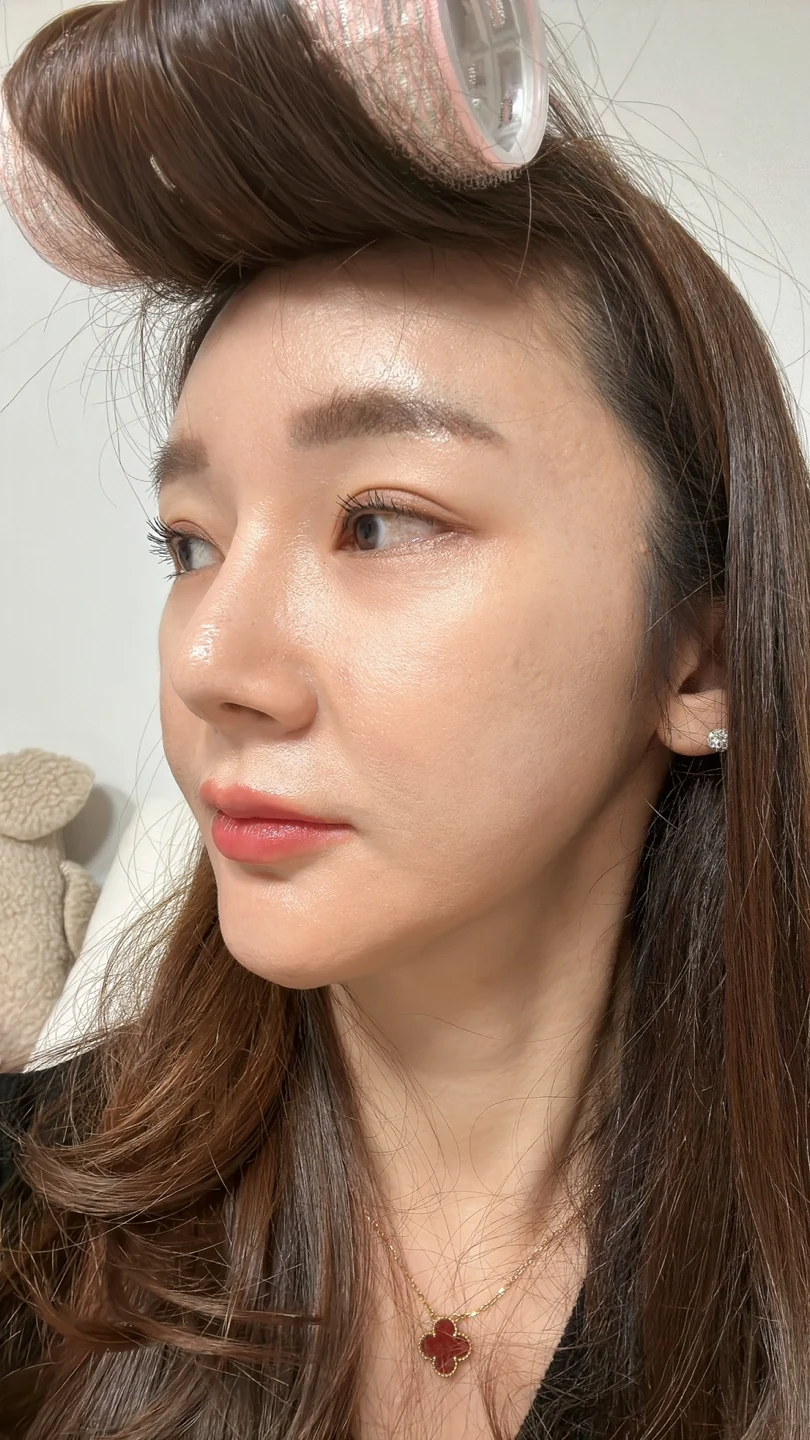 Revision lateral and lower canthoplasty: three-month timeline · Case 031 at Answer Plastic Surgery. Oblique view — 3 weeks at Answer Plastic Surgery.