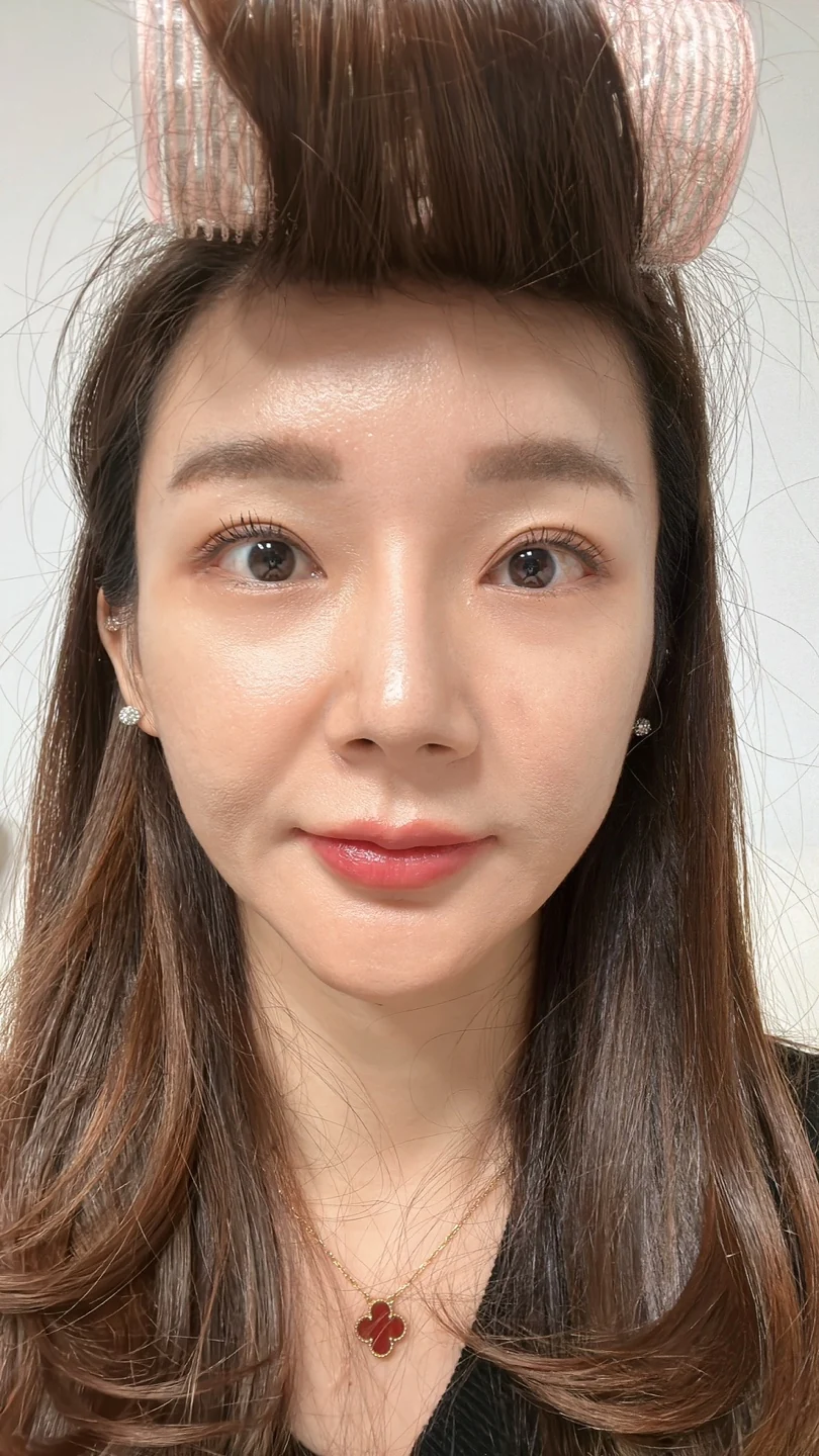Revision lateral and lower canthoplasty: three-month timeline · Case 031 at Answer Plastic Surgery. Front view — 3 weeks at Answer Plastic Surgery.