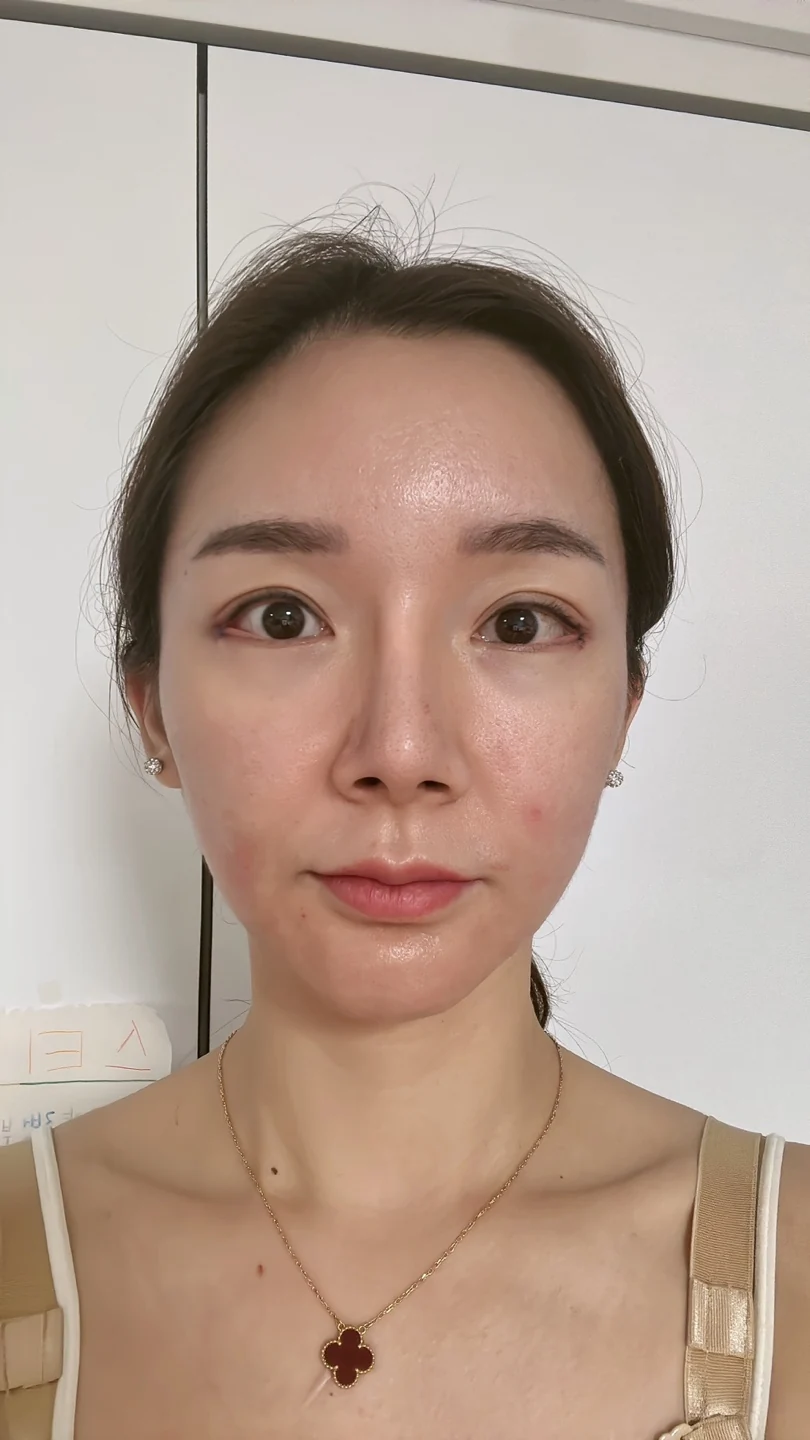 Revision lateral and lower canthoplasty: three-month timeline · Case 031 at Answer Plastic Surgery. Front view — day of surgery at Answer Plastic Surgery.