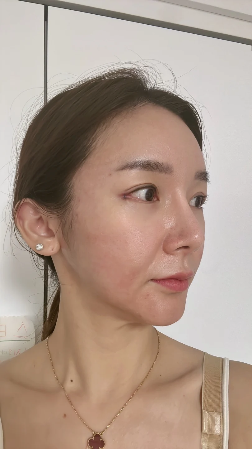 Revision lateral and lower canthoplasty: three-month timeline · Case 031 at Answer Plastic Surgery. Oblique view — day of surgery at Answer Plastic Surgery.