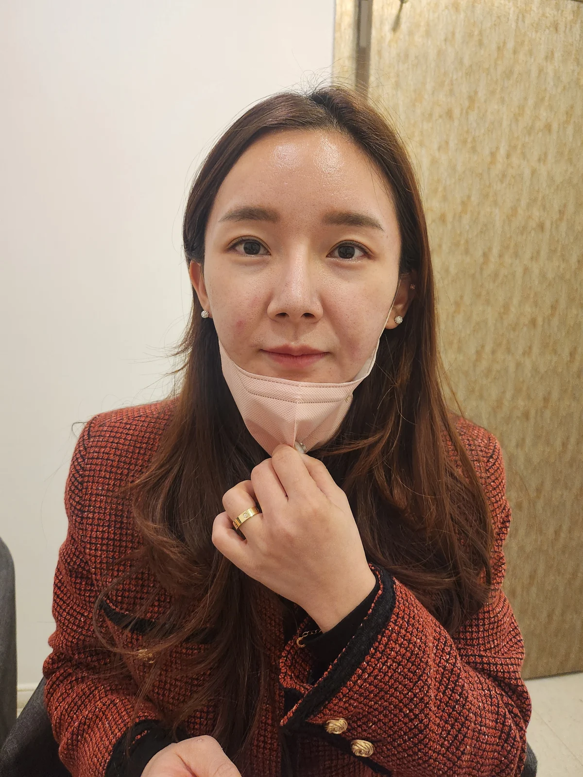 Revision lateral and lower canthoplasty: three-month timeline · Case 031 at Answer Plastic Surgery. Front view — before at Answer Plastic Surgery.