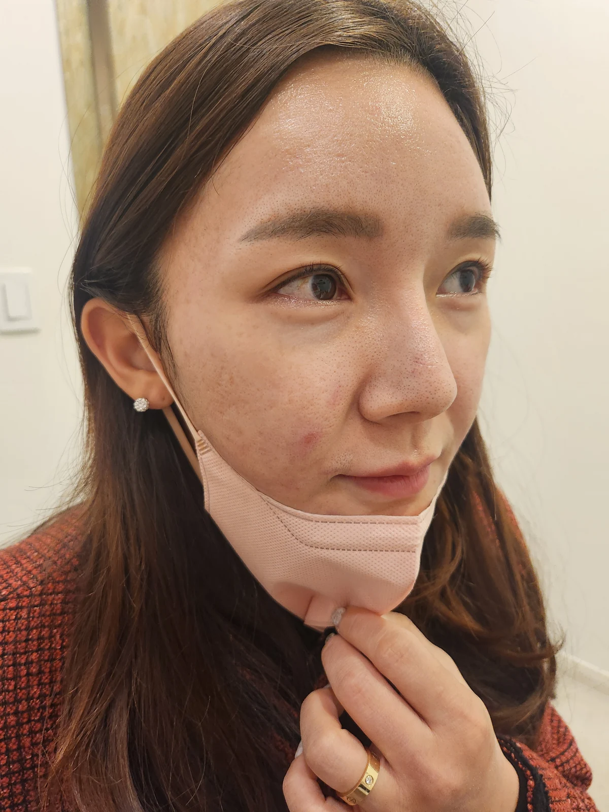 Revision lateral and lower canthoplasty: three-month timeline · Case 031 at Answer Plastic Surgery. Oblique view — before at Answer Plastic Surgery.