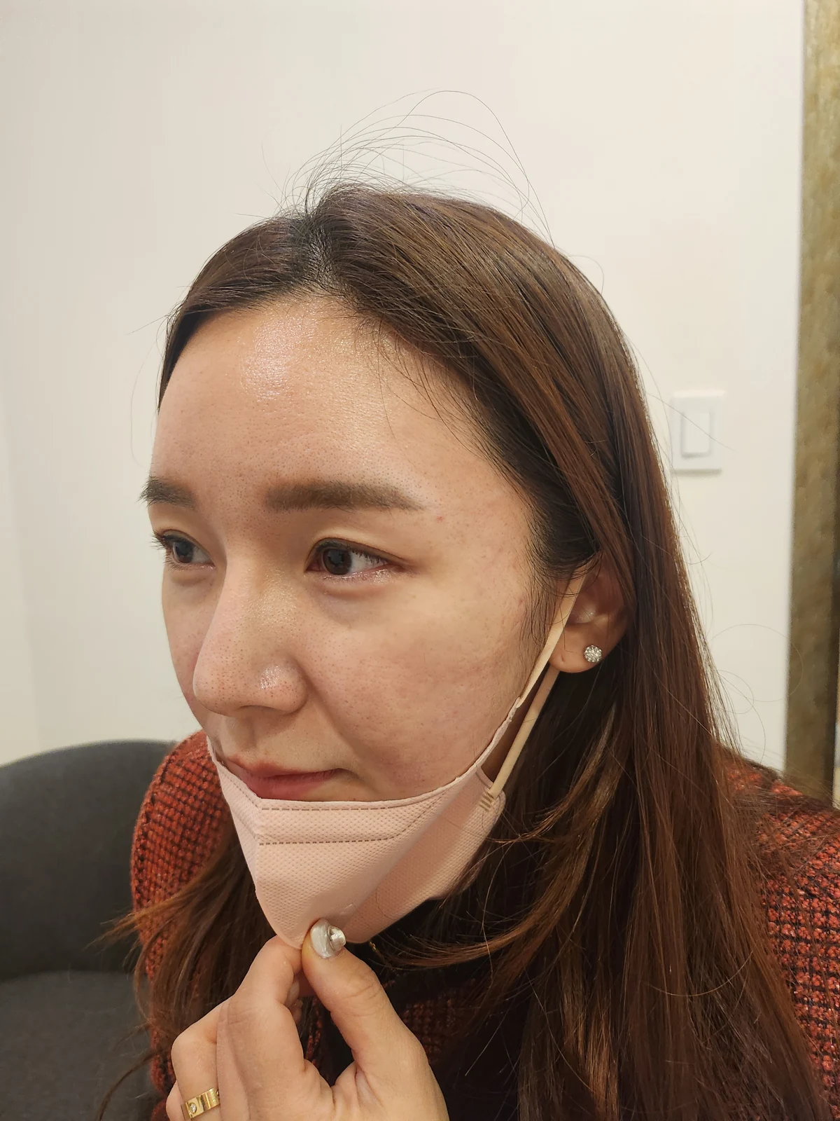 Revision lateral and lower canthoplasty: three-month timeline · Case 031 at Answer Plastic Surgery. Opposite oblique view — before at Answer Plastic Surgery.