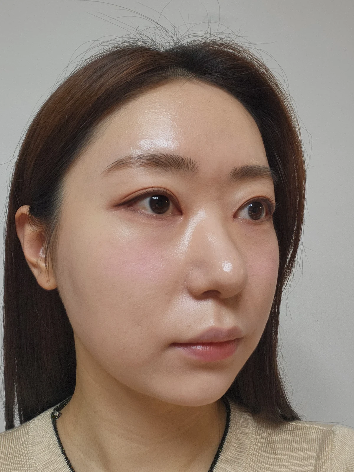 Canthoplasty recovery: day one to one month · Case 032 at Answer Plastic Surgery. Oblique view — 1 month at Answer Plastic Surgery.