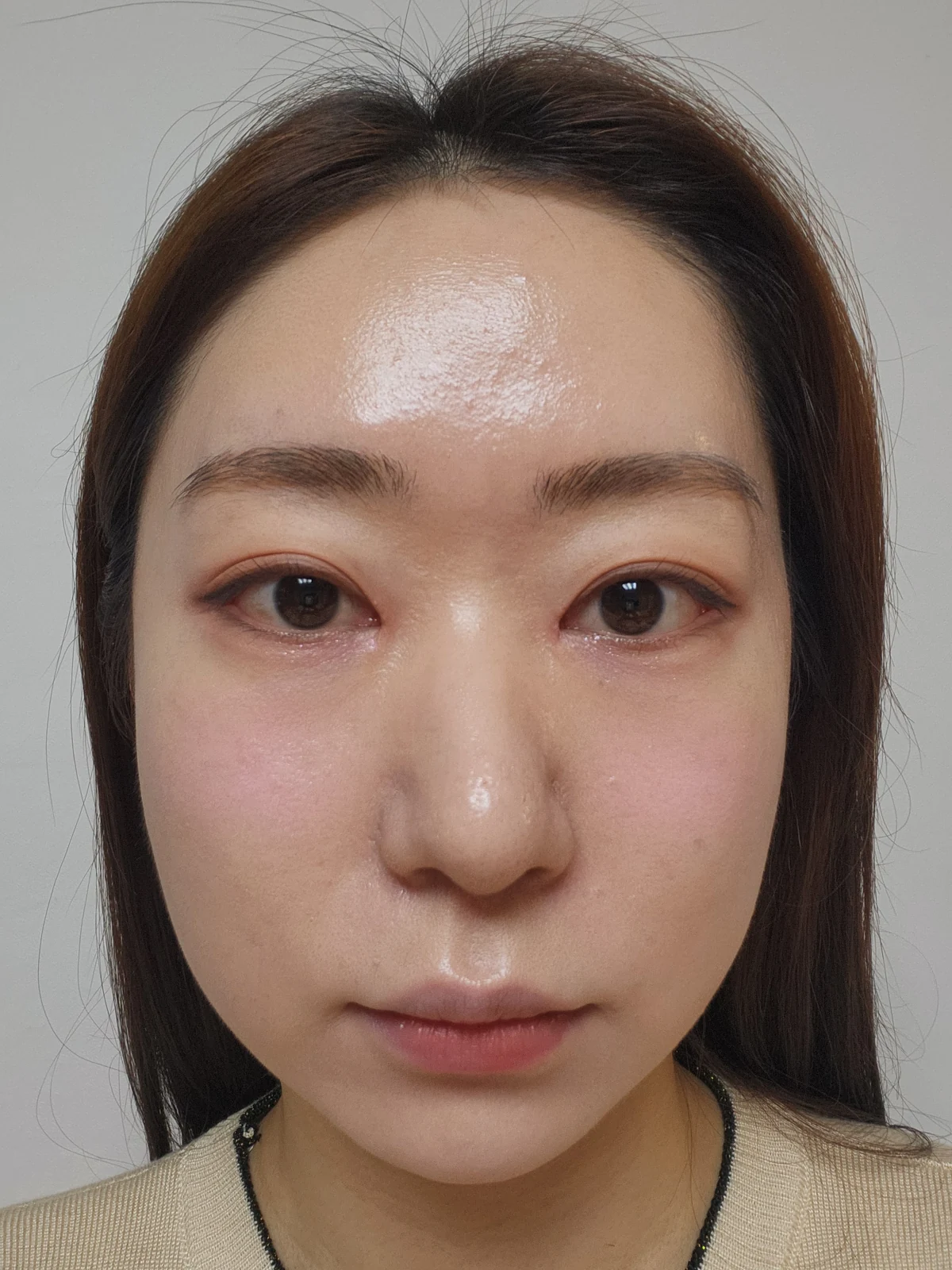 Canthoplasty recovery: day one to one month · Case 032 at Answer Plastic Surgery. Front view — 1 month at Answer Plastic Surgery.