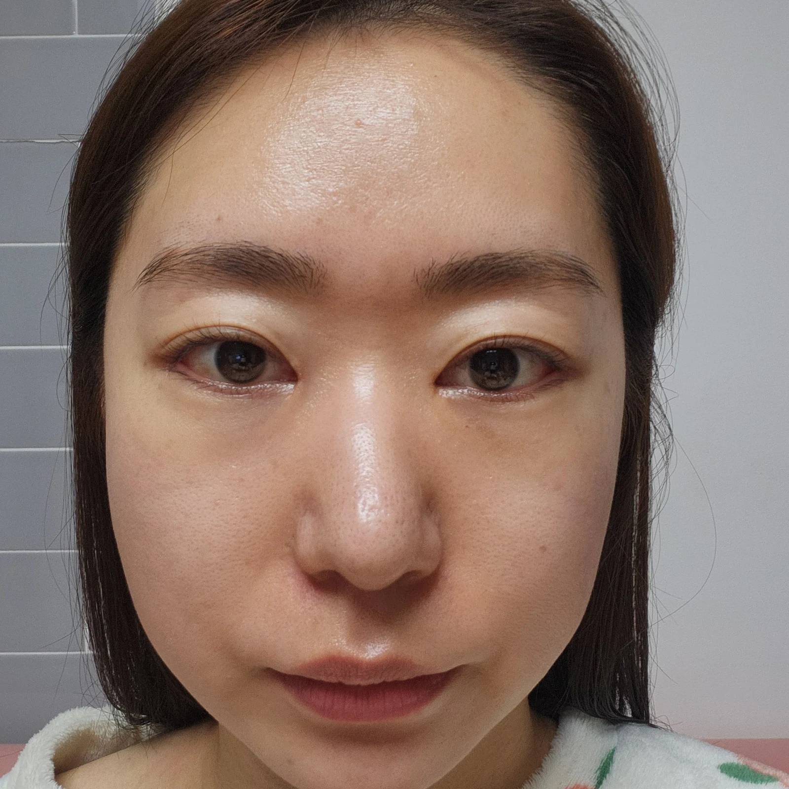 Canthoplasty recovery: day one to one month · Case 032 at Answer Plastic Surgery. Front close-up — 1 week at Answer Plastic Surgery.