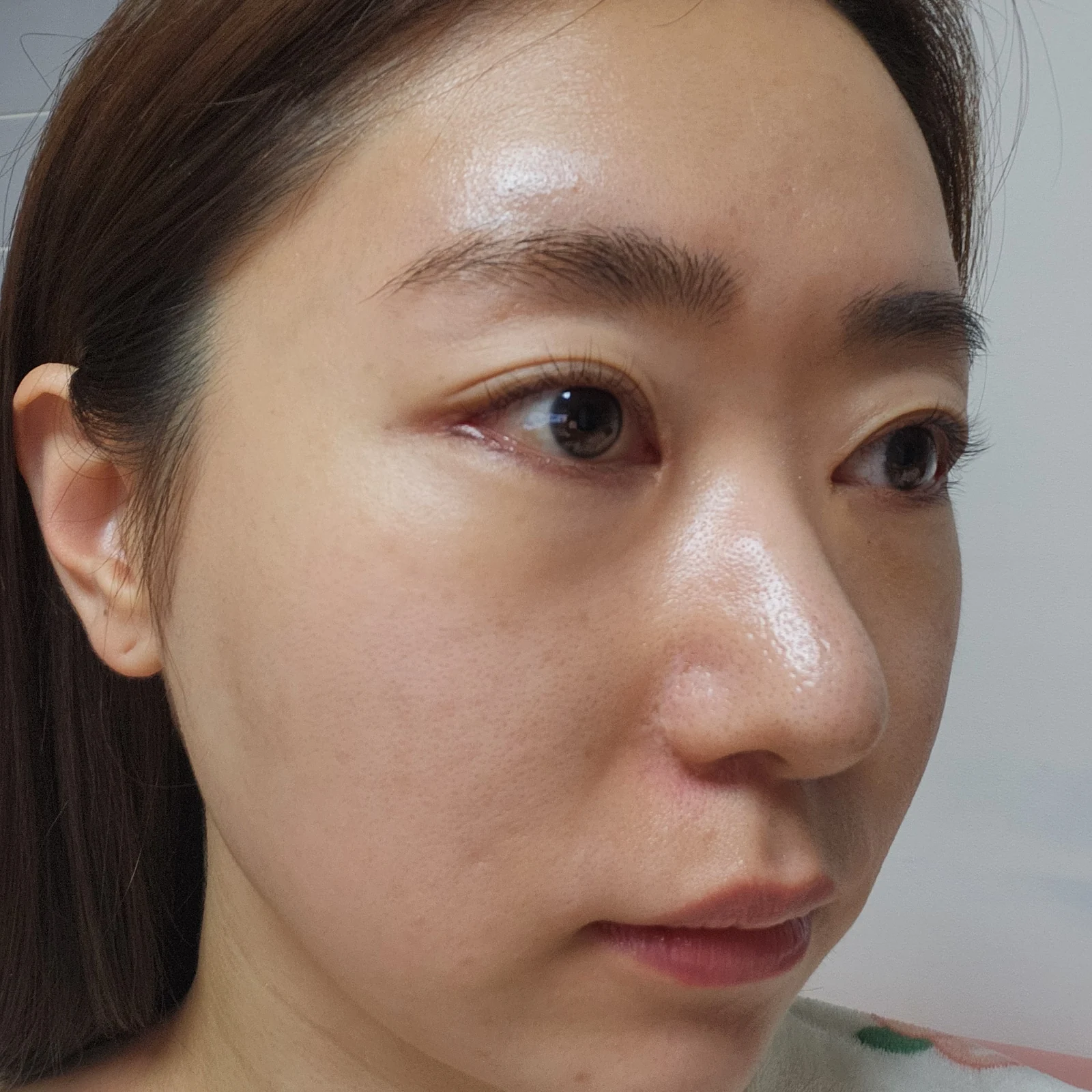 Canthoplasty recovery: day one to one month · Case 032 at Answer Plastic Surgery. Oblique close-up — 1 week at Answer Plastic Surgery.