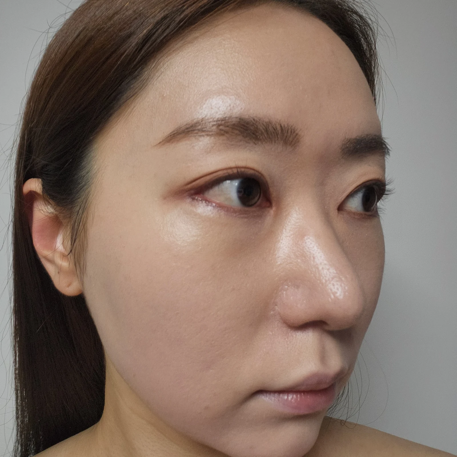 Canthoplasty recovery: day one to one month · Case 032 at Answer Plastic Surgery. Oblique view — 2 weeks at Answer Plastic Surgery.