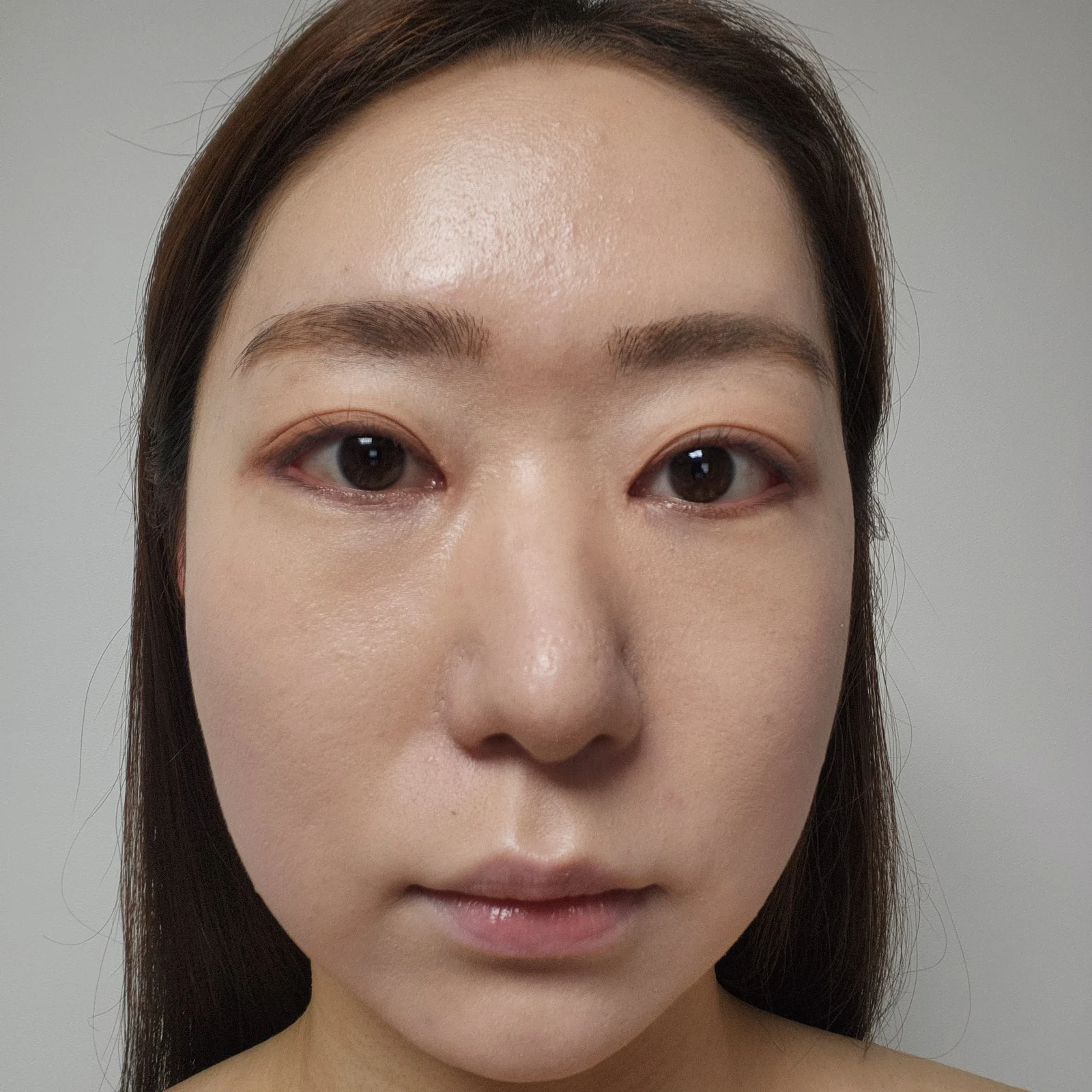 Canthoplasty recovery: day one to one month · Case 032 at Answer Plastic Surgery. Front view — 2 weeks at Answer Plastic Surgery.