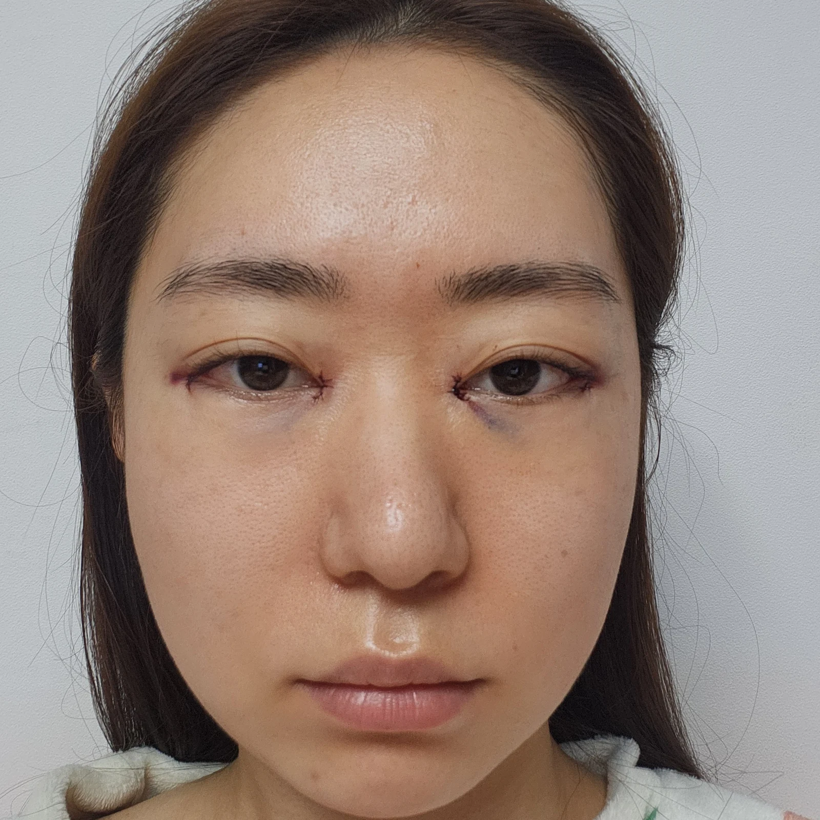 Canthoplasty recovery: day one to one month · Case 032 at Answer Plastic Surgery. Front view — day of surgery at Answer Plastic Surgery.