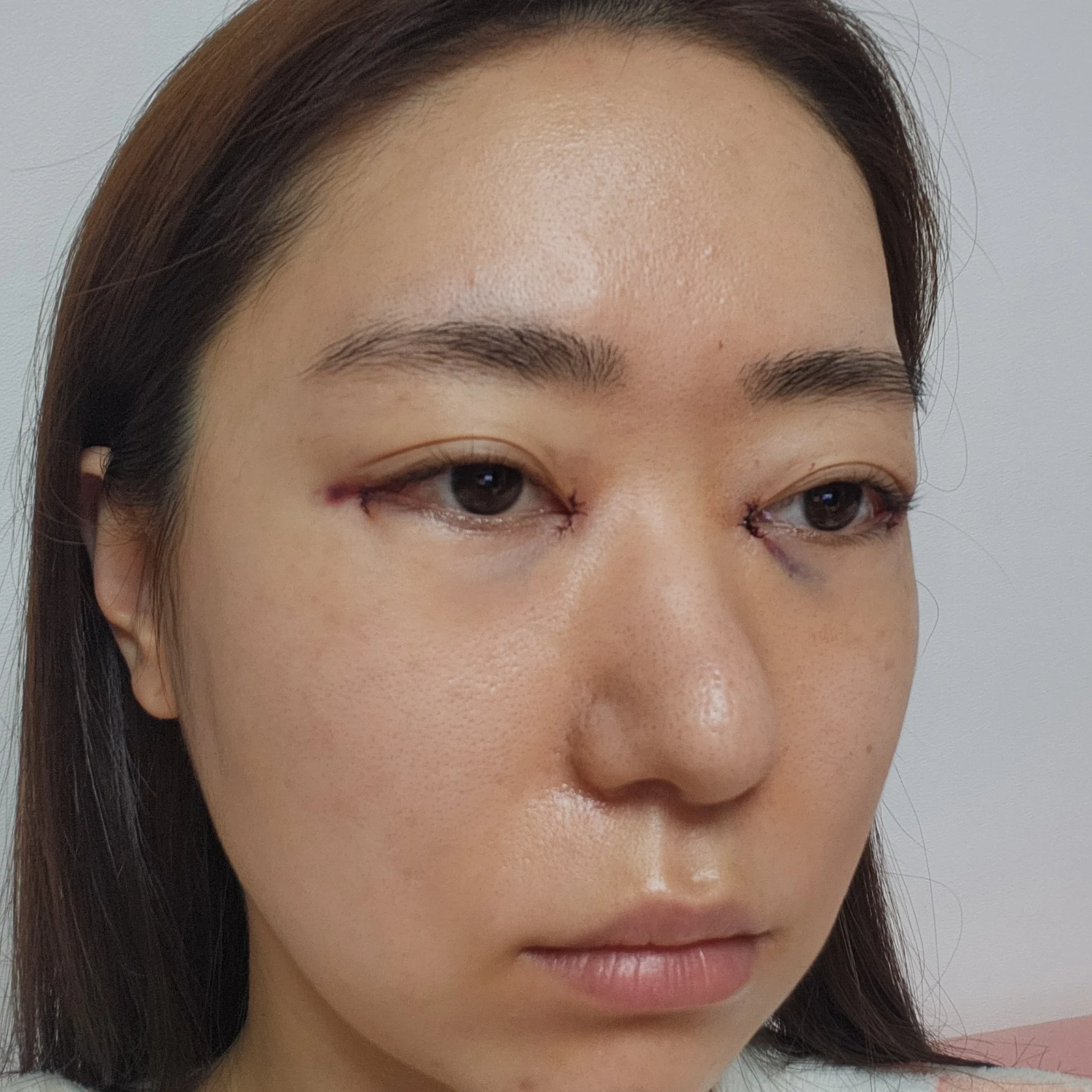 Canthoplasty recovery: day one to one month · Case 032 at Answer Plastic Surgery. Oblique view — day of surgery at Answer Plastic Surgery.