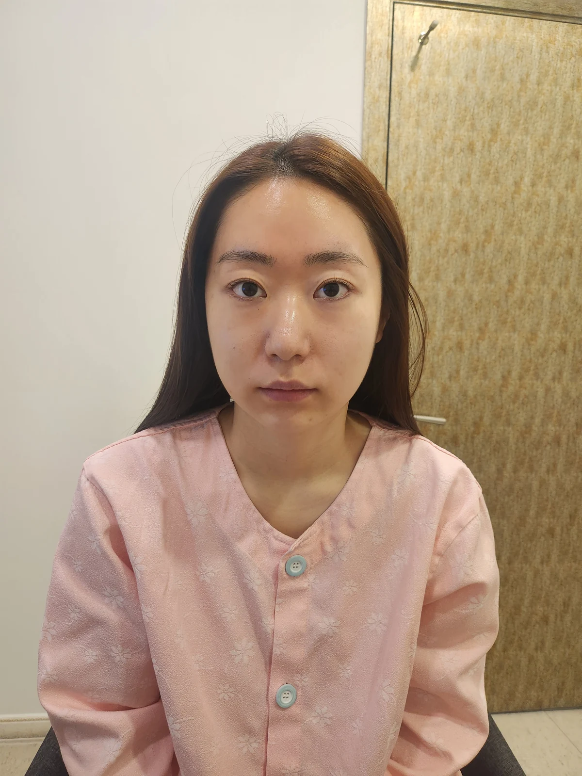 Canthoplasty recovery: day one to one month · Case 032 at Answer Plastic Surgery. Front view — before at Answer Plastic Surgery.