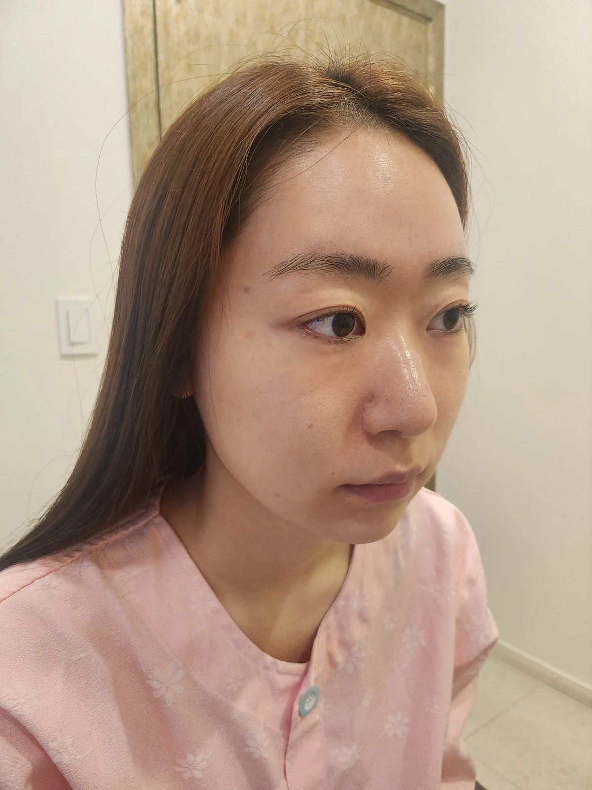 Canthoplasty recovery: day one to one month · Case 032 at Answer Plastic Surgery. Oblique view — before at Answer Plastic Surgery.