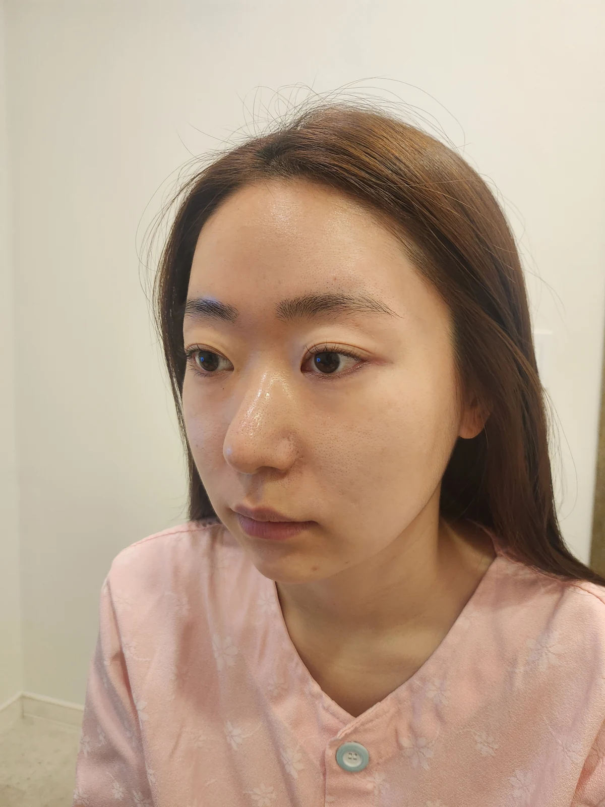 Canthoplasty recovery: day one to one month · Case 032 at Answer Plastic Surgery. Opposite oblique view — before at Answer Plastic Surgery.