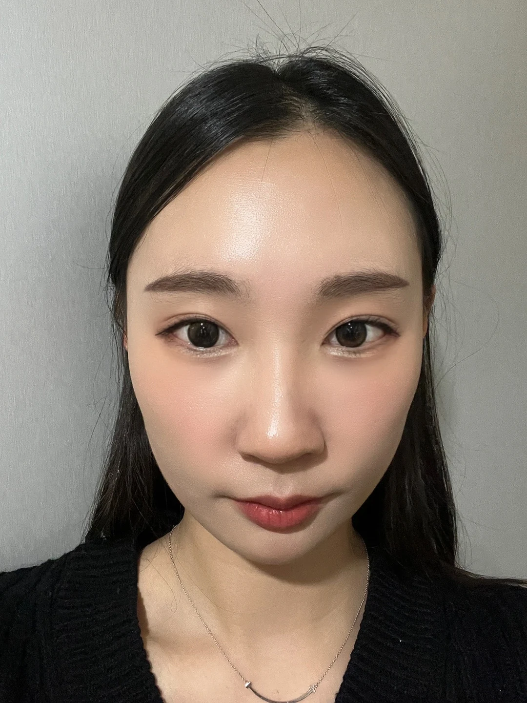 Eye-area comparison with a two-week follow-up · Case 033 at Answer Plastic Surgery. Front view with makeup — 2 weeks at Answer Plastic Surgery.