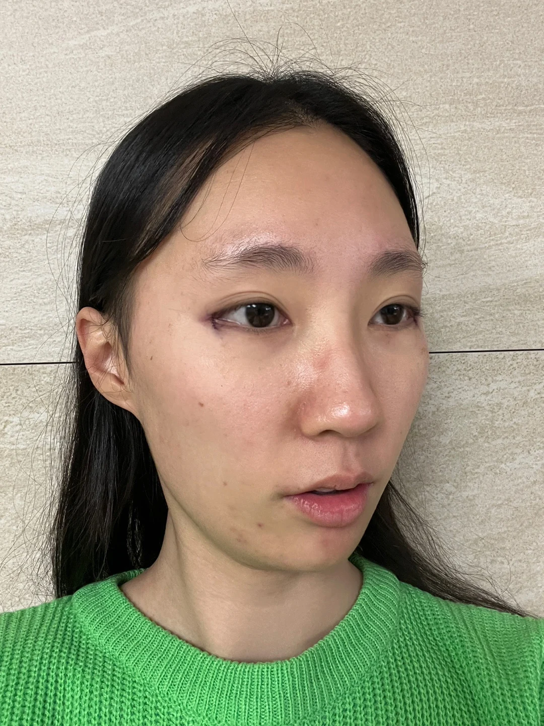 Eye-area comparison with a two-week follow-up · Case 033 at Answer Plastic Surgery. Oblique view — day of treatment at Answer Plastic Surgery.