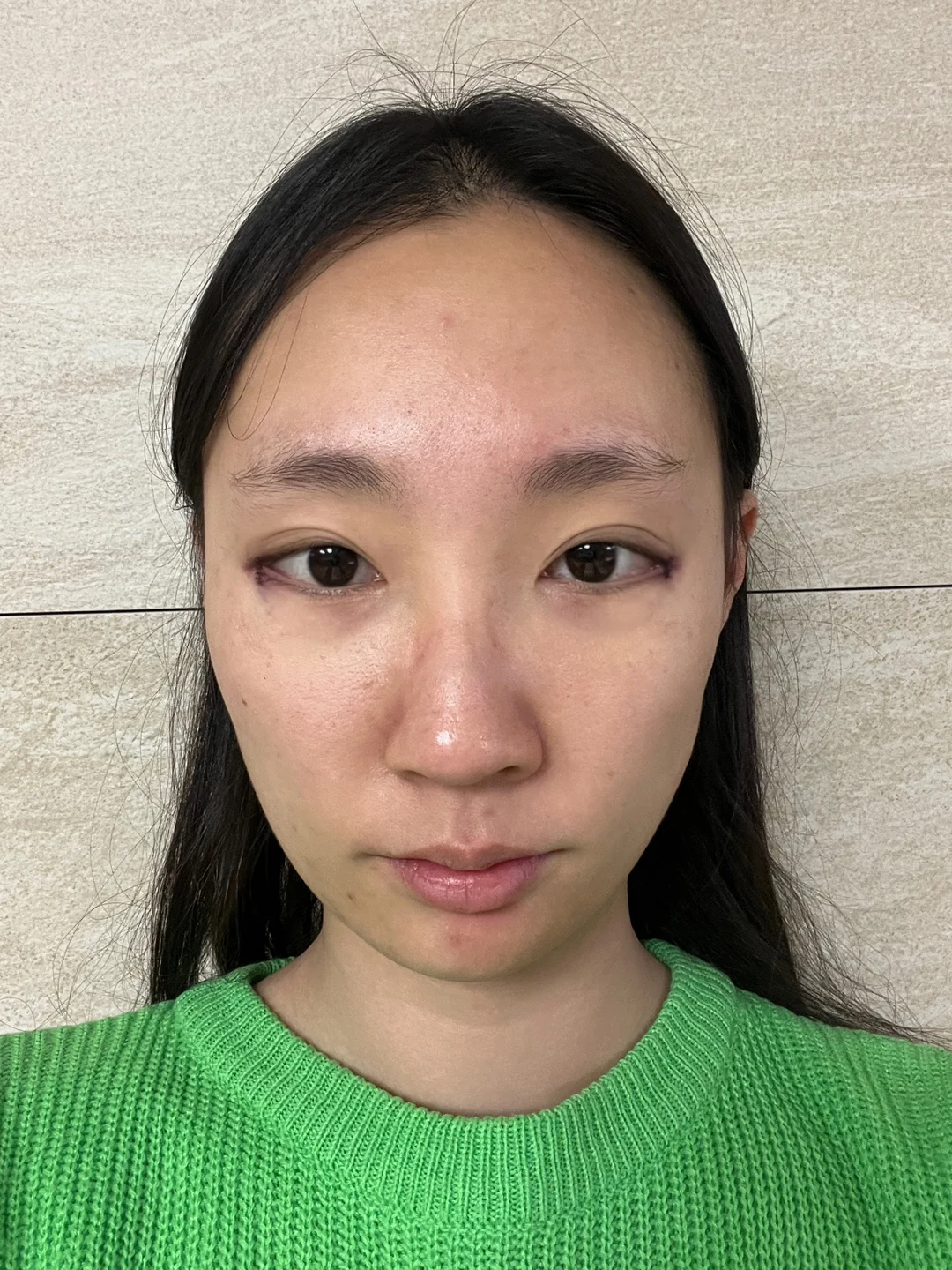 Eye-area comparison with a two-week follow-up · Case 033 at Answer Plastic Surgery. Front view — day of treatment at Answer Plastic Surgery.