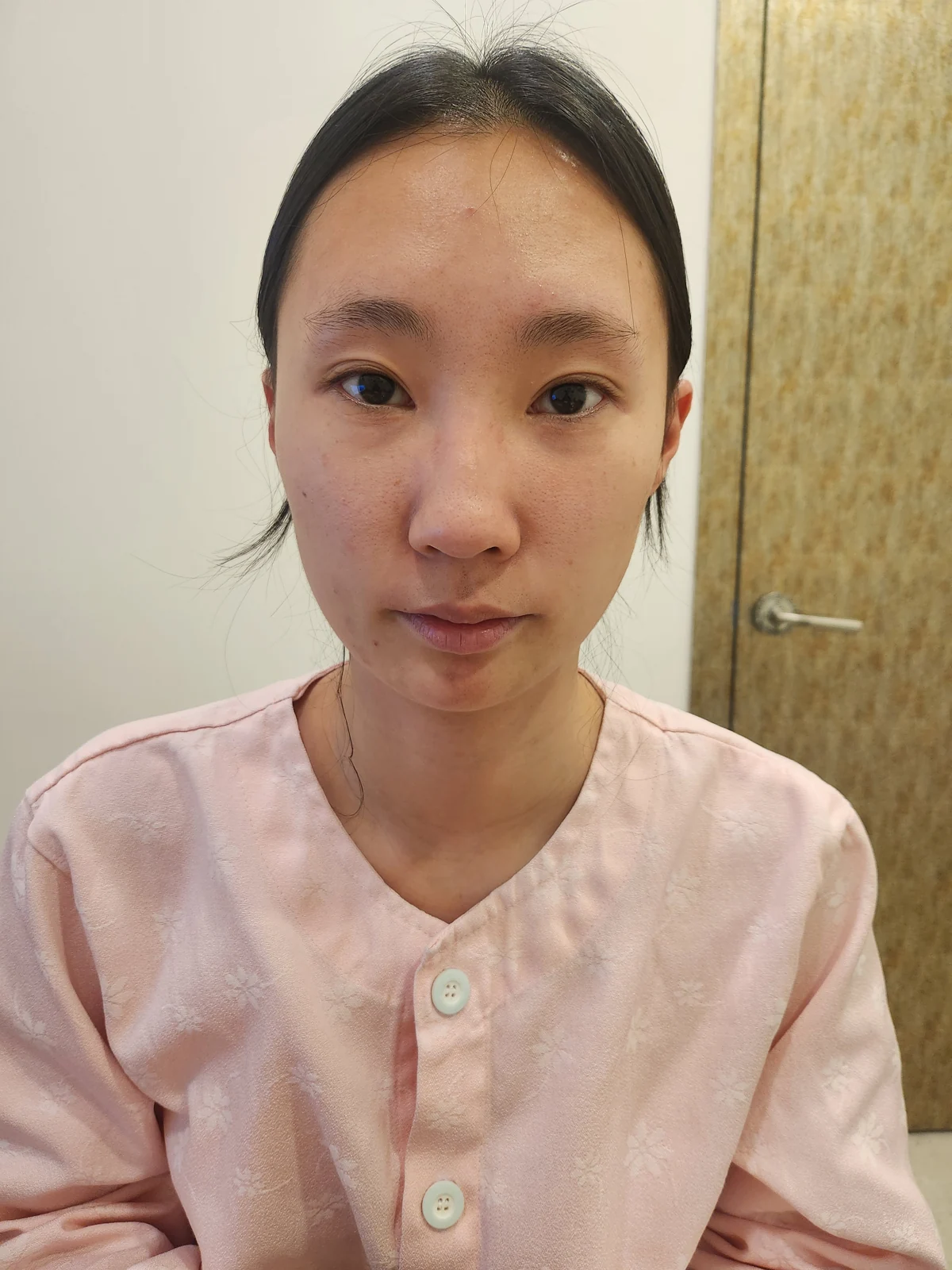 Eye-area comparison with a two-week follow-up · Case 033 at Answer Plastic Surgery. Front view — before at Answer Plastic Surgery.