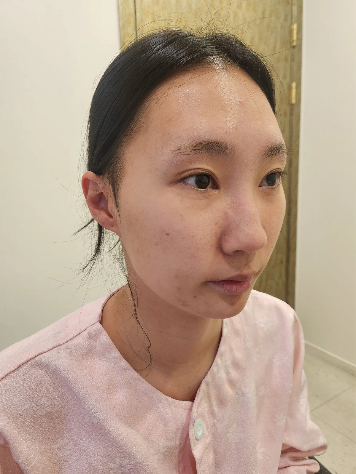 Eye-area comparison with a two-week follow-up · Case 033 at Answer Plastic Surgery. Oblique view — before at Answer Plastic Surgery.