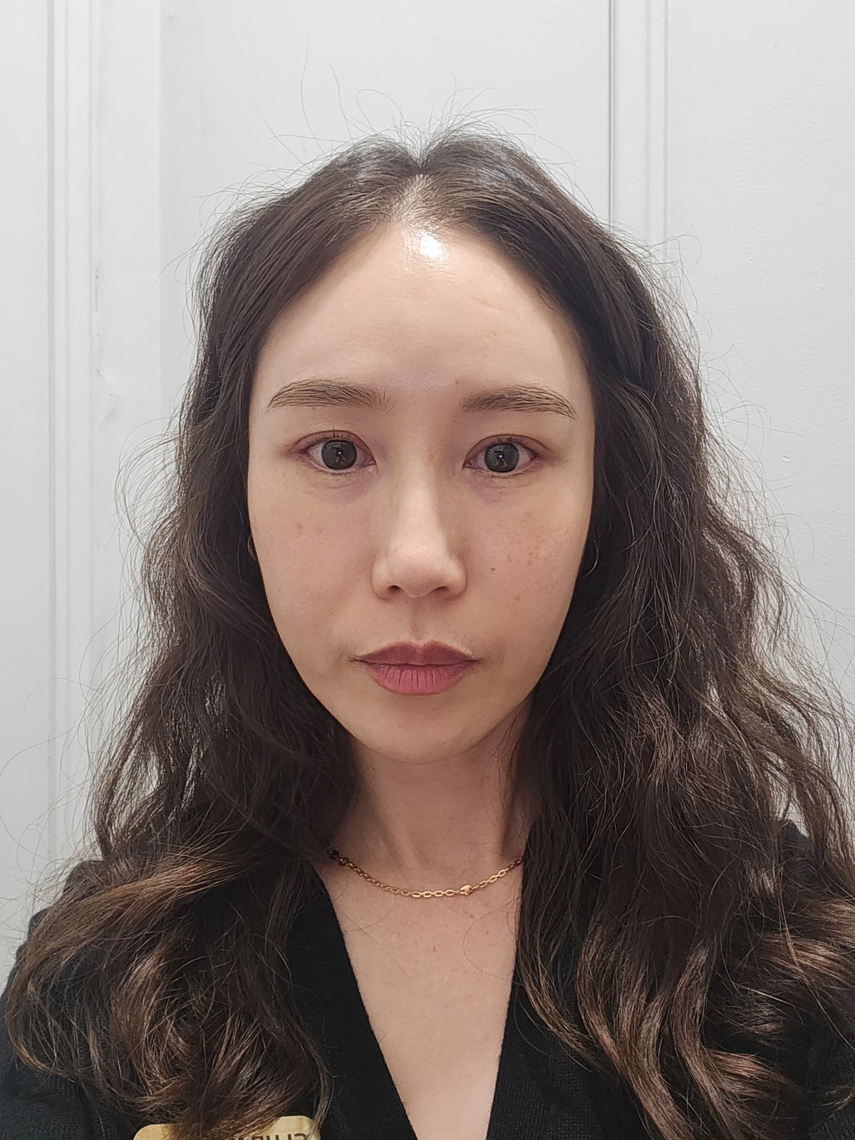 Eyelid surgery: the two-week recovery stage · Case 034 at Answer Plastic Surgery. Front view — 2 weeks after surgery at Answer Plastic Surgery.