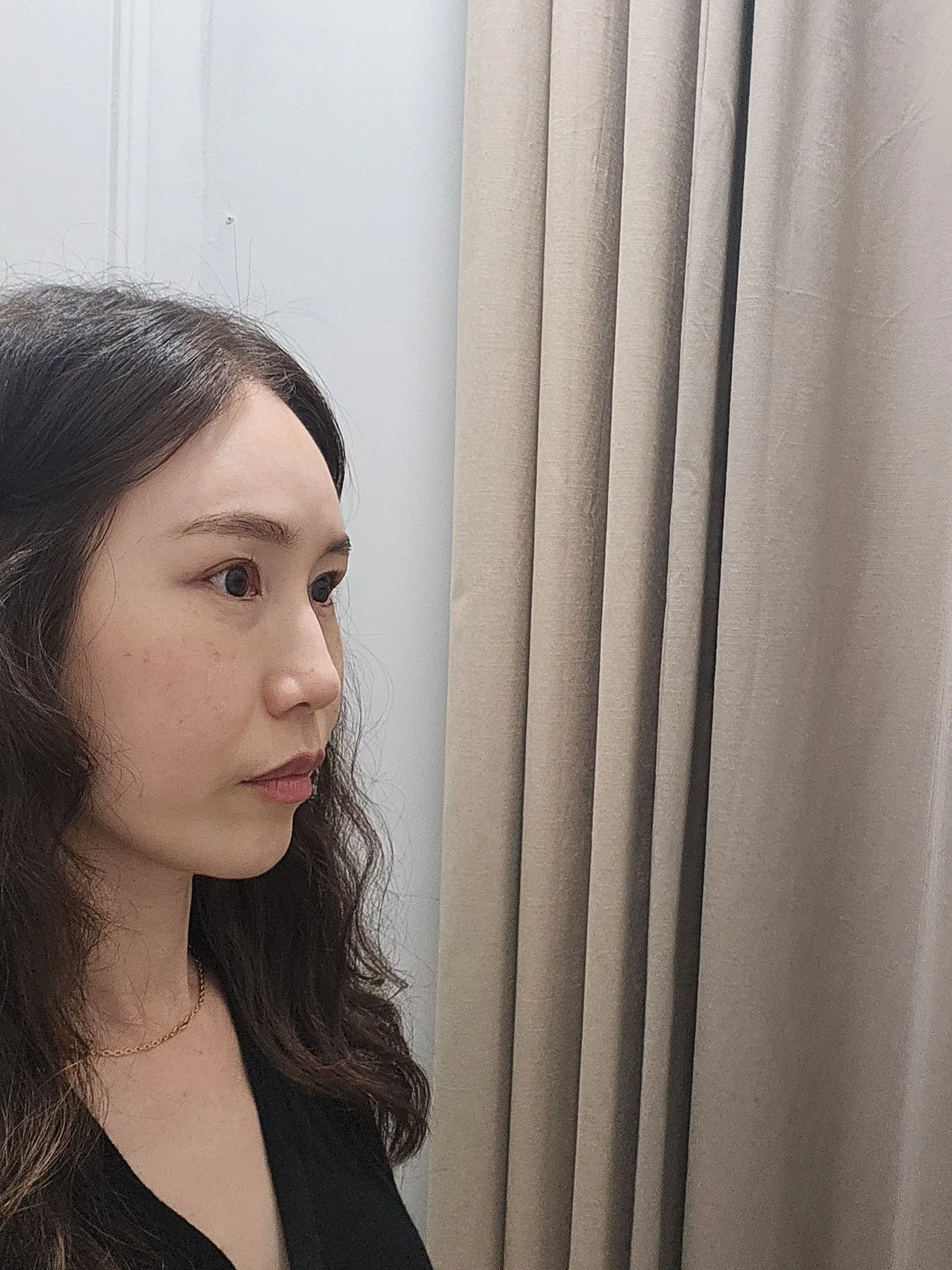Eyelid surgery: the two-week recovery stage · Case 034 at Answer Plastic Surgery. Oblique view — 2 weeks after surgery at Answer Plastic Surgery.