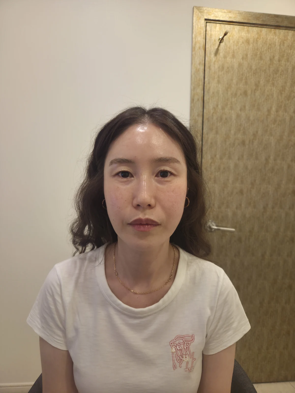 Eyelid surgery: the two-week recovery stage · Case 034 at Answer Plastic Surgery. Front view — before at Answer Plastic Surgery.