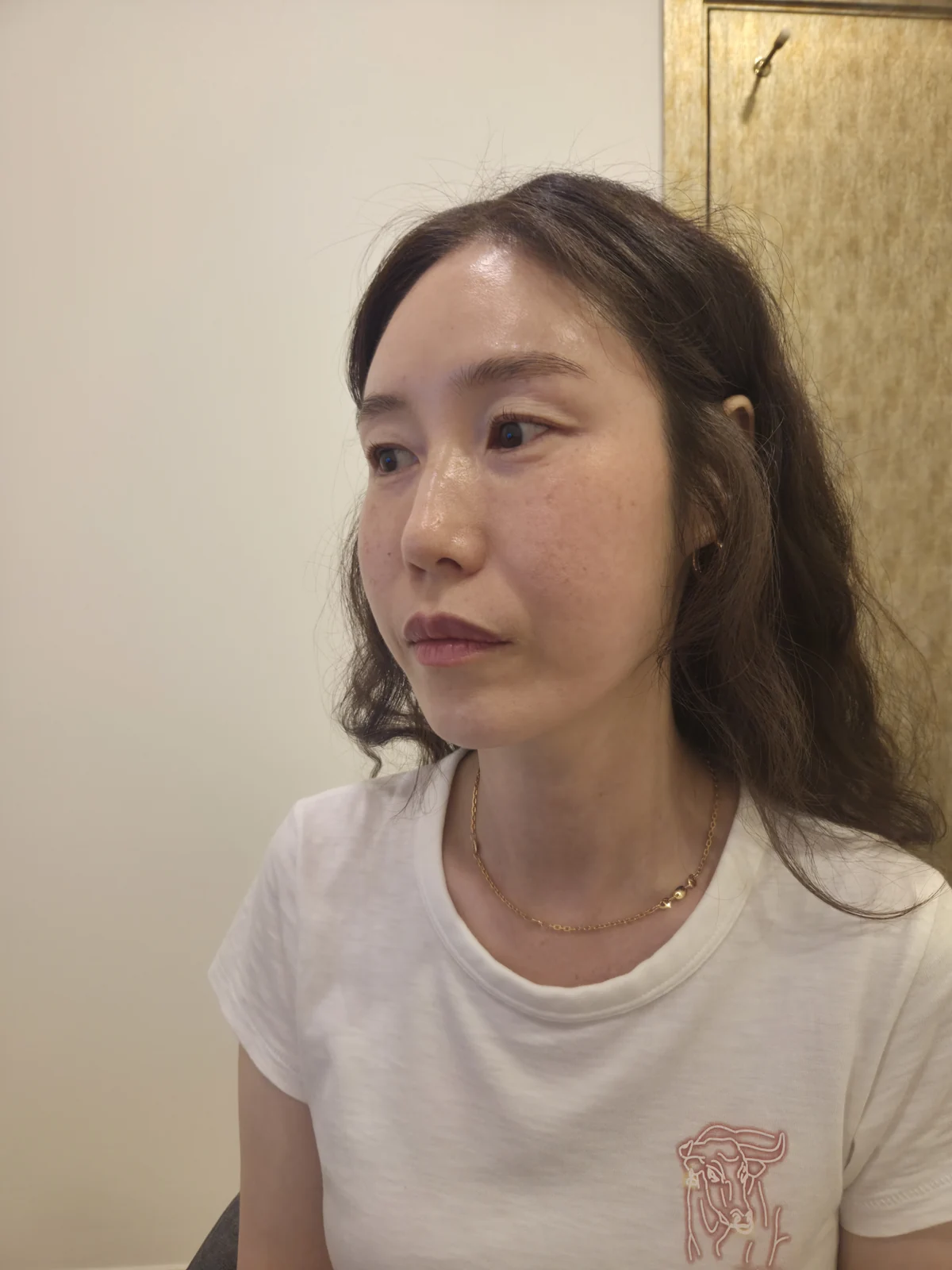Eyelid surgery: the two-week recovery stage · Case 034 at Answer Plastic Surgery. Oblique view — before at Answer Plastic Surgery.