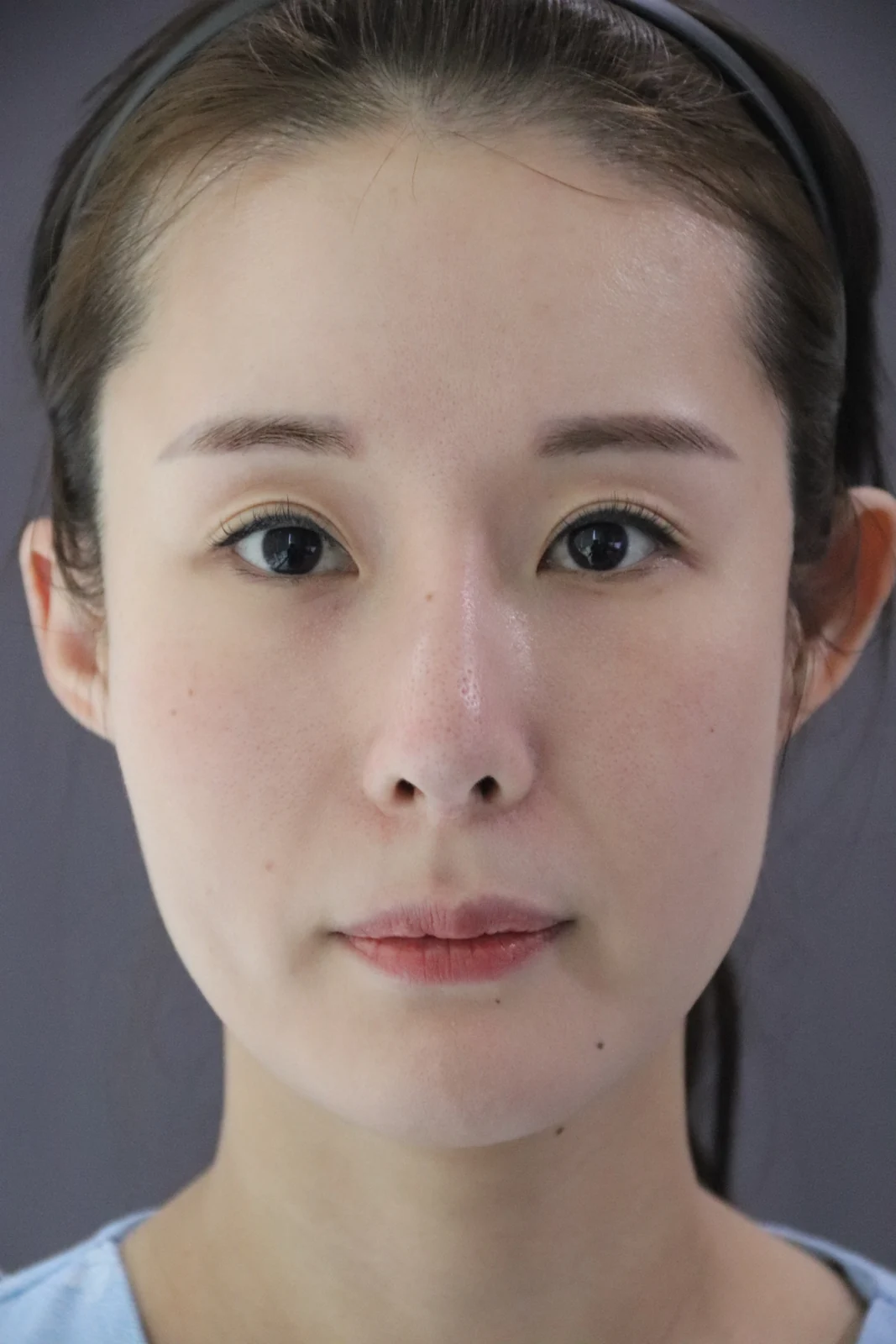 Wonder eye-corner surgery with a fuller eyelid crease: early recovery · Case 035 at Answer Plastic Surgery. Front portrait — before at Answer Plastic Surgery.