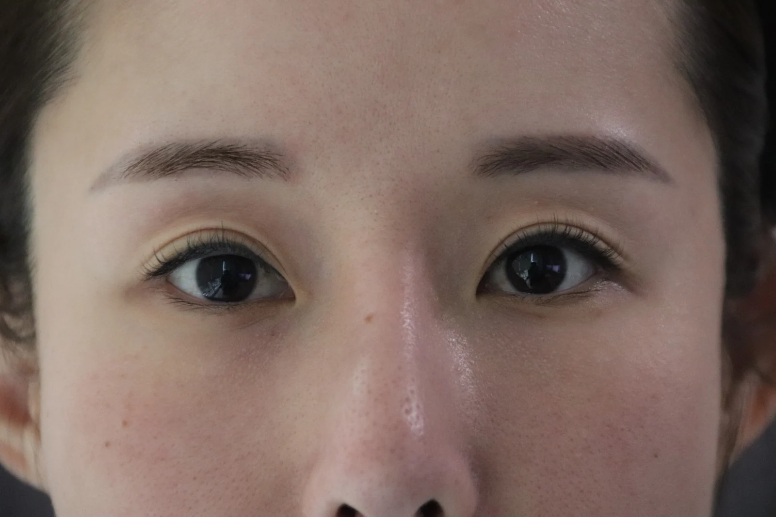Wonder eye-corner surgery with a fuller eyelid crease: early recovery · Case 035 at Answer Plastic Surgery. Close view of both eyes — before at Answer Plastic Surgery.