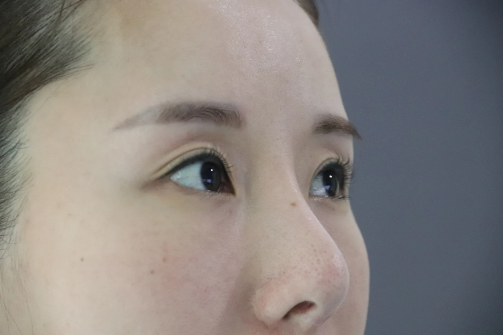 Wonder eye-corner surgery with a fuller eyelid crease: early recovery · Case 035 at Answer Plastic Surgery. Oblique eye view — before at Answer Plastic Surgery.