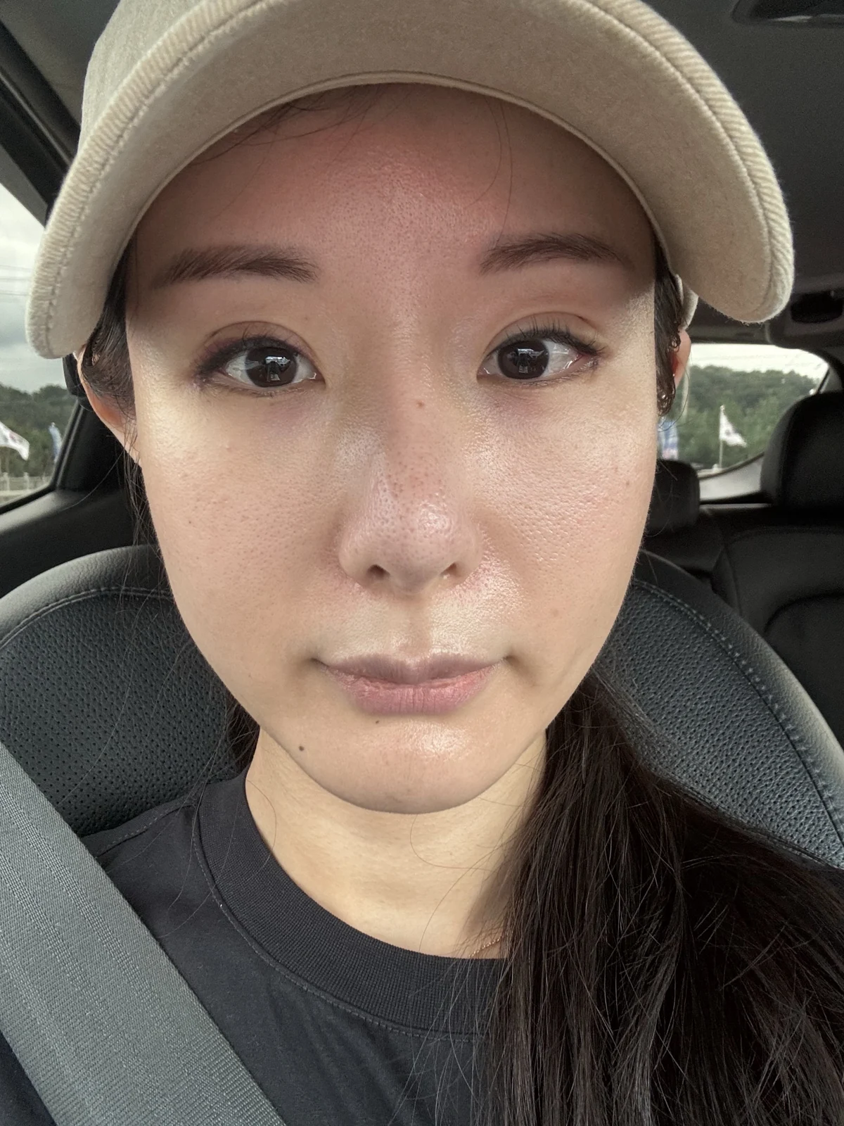 Wonder eye-corner surgery with a fuller eyelid crease: early recovery · Case 035 at Answer Plastic Surgery. Front view — 1 week, before stitch removal at Answer Plastic Surgery.