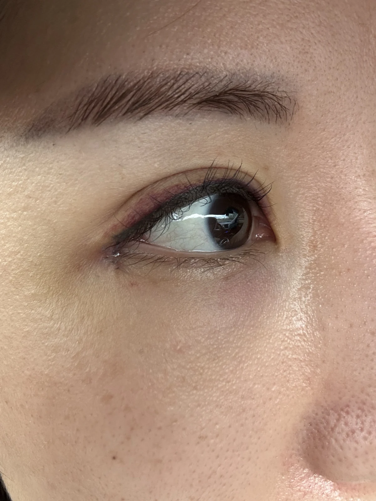 Wonder eye-corner surgery with a fuller eyelid crease: early recovery · Case 035 at Answer Plastic Surgery. Close eye-corner view — 1 week, before stitch removal at Answer Plastic Surgery.